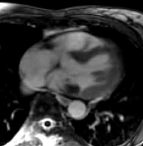 Mitral Annular Calcification MAC | Heart