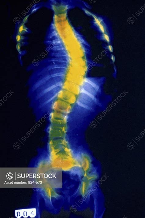 X-Ray Showing Rickets Disease - SuperStock