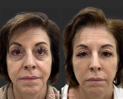 Under Eye Fillers - Before & After Results at Skinly