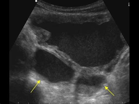 Urinary Tract and male reproductive system | 2.2 Bladder : Case 2.2.3 Miscellaneous bladder and ...