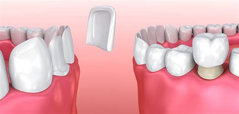 PORCELAIN VENEERS VERSUS DENTAL CROWNS