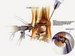 Medical Treatment Pictures-for Better Understanding: Arthroscopic Knee Synovectomy Surgery ...