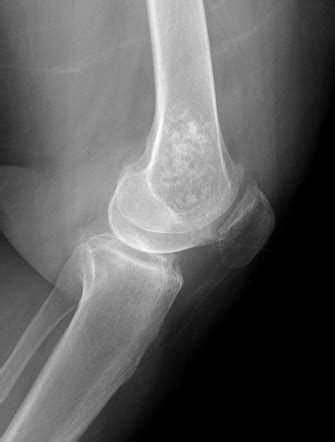 Enchondroma - distal femur | Image | Radiopaedia.org