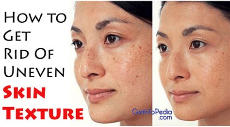 How To Get Rid Of Uneven Skin Texture - Getinfopedia.com