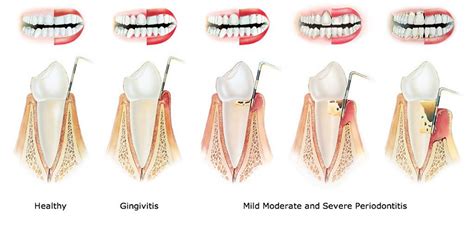 Periodontics | Vincentia Dental Care | Vincentia, NSW