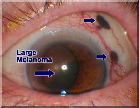 Melanoma of the eye. Causes, symptoms, treatment Melanoma of the eye