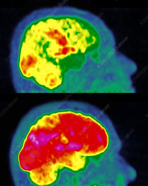 Alzheimer's disease, PET scan - Stock Image - C038/4518 - Science Photo ...