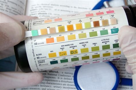 Urinalysis: A Simple Test with Complicated Interpretation - Journal of Urgent Care Medicine