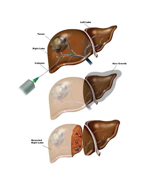 Advanced Approaches of Colorectal Cancer with Liver Metastases - Penn ...