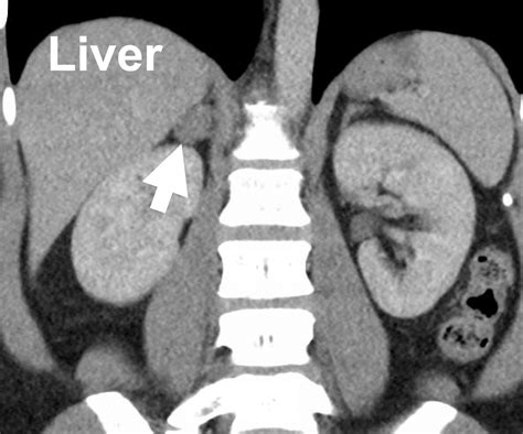 Conn Syndrome - Scans and X-Rays