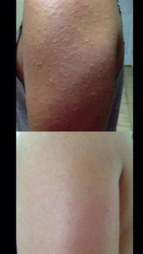 Do you have Keratosis Pilaris? Those little bumps on the back of the arms? I have the solution ...