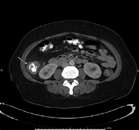 CT scan of abdomen with contrast with apple-core lesion in ascending... | Download Scientific ...