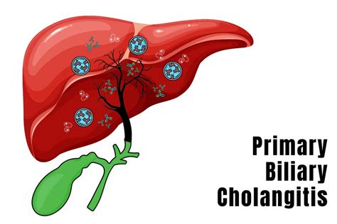 What is Primary Biliary Cholangitis? - ENCORE Research Group