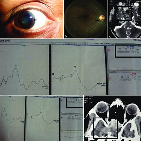 (a) Anterior segment photograph showing relative afferent pupillary ...