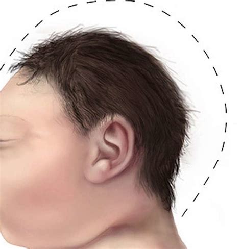 Microcephaly: Causes, symptoms, and treatment