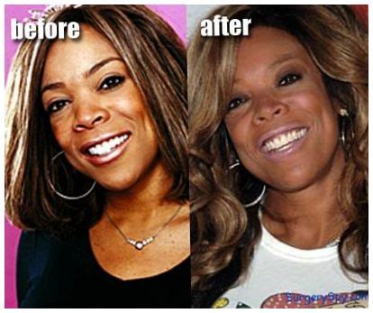 Wendy Williams tummy tuck before and after photos ~ Celebrity Plastic Surgery News | Before and ...