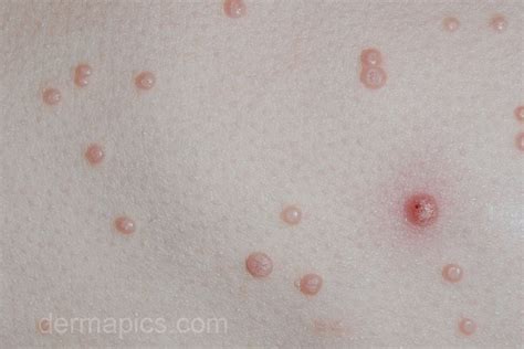 Molluscum Scars Molluscum contagiosum: pictures and clinical | Molluscum Contagiosum Home Remedy