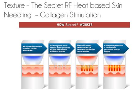 The Secret Radio Frequency (RF) Skin Micro-needling - Facelove - St Kilda, Melbourne