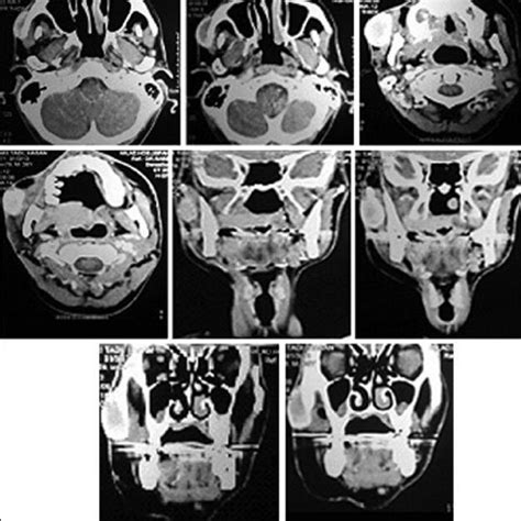 CT image, Axial view, soft tissue windowing, showe a soft tissue mass ...