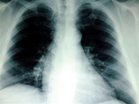 Silicosis: The silent lung disease killing our tradies | 7NEWS.com.au