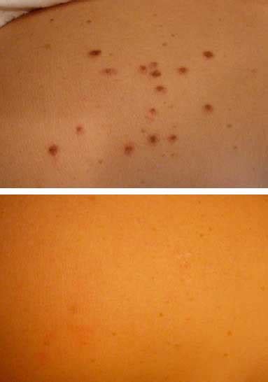 Cherry Angioma Removal (Carlisle) - Leading Angioma Treatment | VL Aesthetics