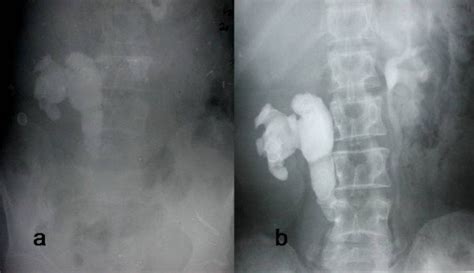 a) Plain x-ray KUB revealing a large right staghorn calculus extending... | Download Scientific ...