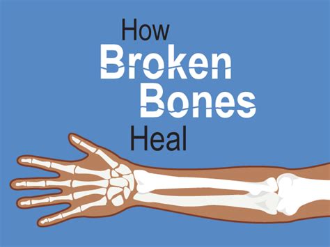 How To Repair A Broken Bone - Longfamily26