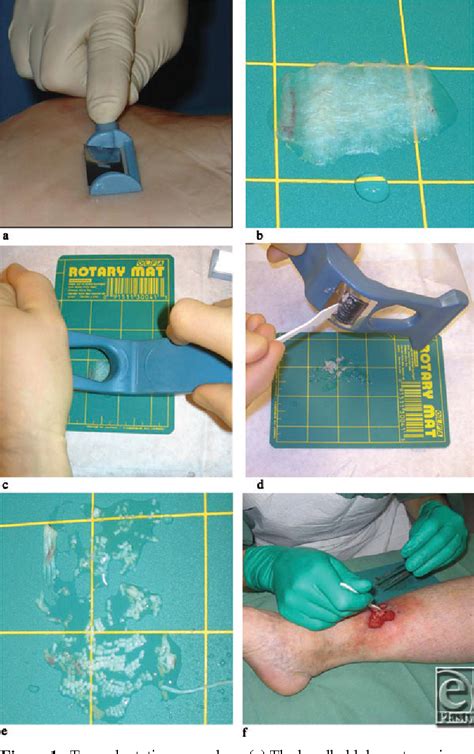 Figure 1 from Fast and Standardized Skin Grafting of Leg Wounds With a New Technique: Report of ...