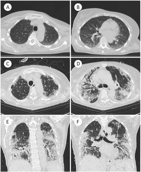 Cystic Fibrosis Lungs Vs Healthy Lungs