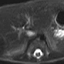 (PDF) Scrotal Hematoma as a Sign of Subcapsular Liver Hematoma in a Preterm Infant