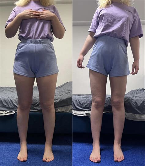 Before/After of Thigh + Love Handle Liposuction, Hip Dip Fat Grafting, 3 weeks post op (-12 cm ...