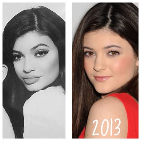 Kylie Jenner before and after plastic surgery | Kylie jenner plastic ...