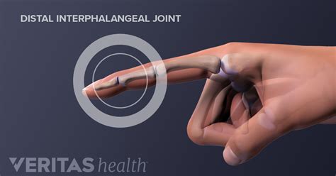 Distal Interphalangeal (DIP) Joints Definition | Defined by Arthritis-Health