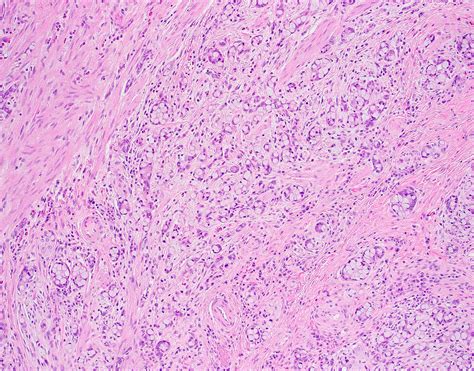 Pathology Outlines - Goblet cell adenocarcinoma