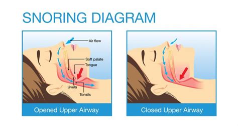 Loud snoring will be a very challenging situation to cope with, both for the person who snores ...