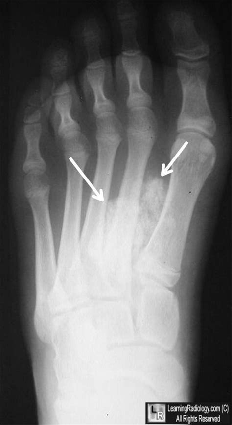 Image result for synovial sarcoma radiology | Radiology, Radiology imaging, Radiology nursing