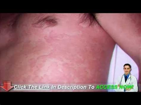 Home Treatment for Heat Hives That Will Work - YouTube