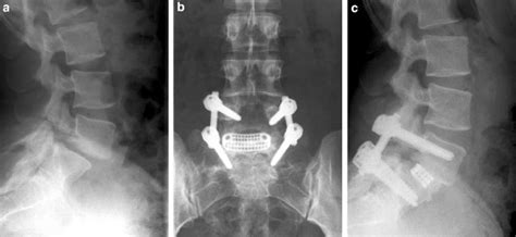 a Lateral preoperative radiograph of a patient with an isthmic... | Download Scientific Diagram