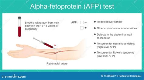 Alpha-fetoprotein AFP Test. Stock Illustration - Illustration of illness, artery: 159655327