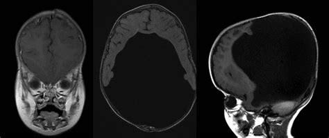 Holoprosencephaly; Arhinencephaly; Alobar Holoprosencephaly; Lobar ...