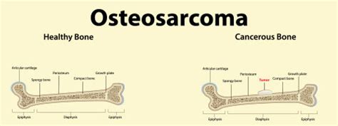 Osteosarcoma: Causes, Symptoms and Treatment