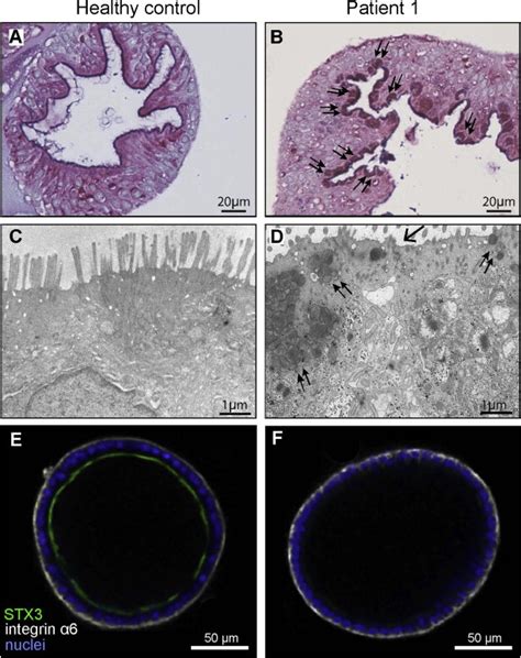 Loss of Syntaxin 3 Causes Variant Microvillus Inclusion Disease - Gastroenterology