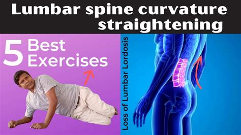 Loss Of Lumbar Lordosis Exercises