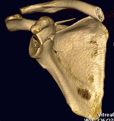 Glenoid & Scapula Fractures | The Bone School