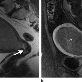 (PDF) FIGO Staging System for Endometrial Cancer: Added Benefits of MR ...