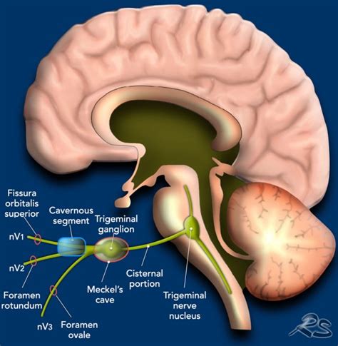 Trigeminal Nerve Mri Sagittal