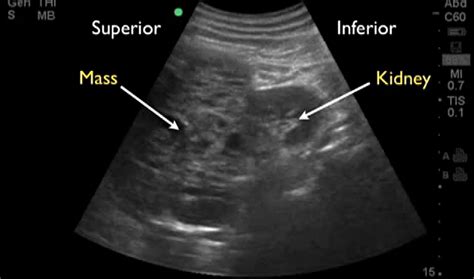 ultrasound pictures of kidney tumors - کامل (مولیزی)