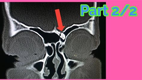 CT scan Cisternogram part 2/2 - YouTube