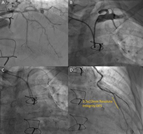 A simple technique for IMA graft angiography and PCI using contralateral radial access - The ...