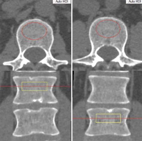 Prevalence of osteoporosis and osteopenia diagnosed using quantitative CT in 296 consecutive ...